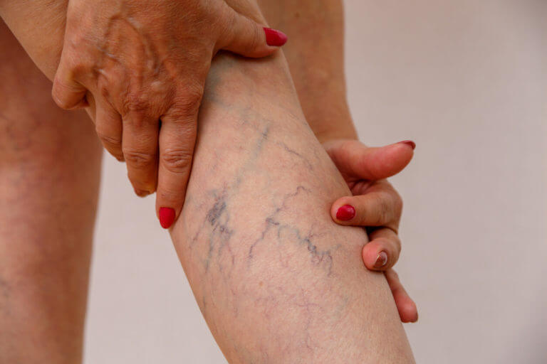 Elderly woman having vericose veins